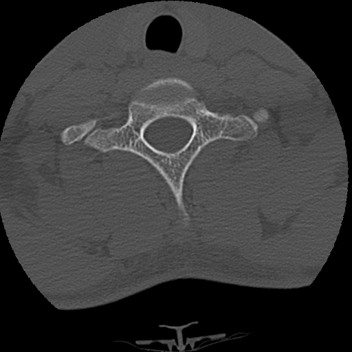 Apical pneumothorax on cervical spine CT (Radiopaedia 45343-49368 Axial bone window 75).jpg