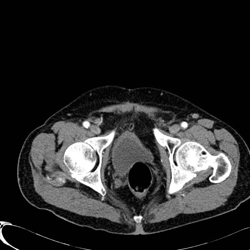 File:Appendiceal adenocarcinoma complicated by retroperitoneal abscess (Radiopaedia 58007-65039 B 136).jpg
