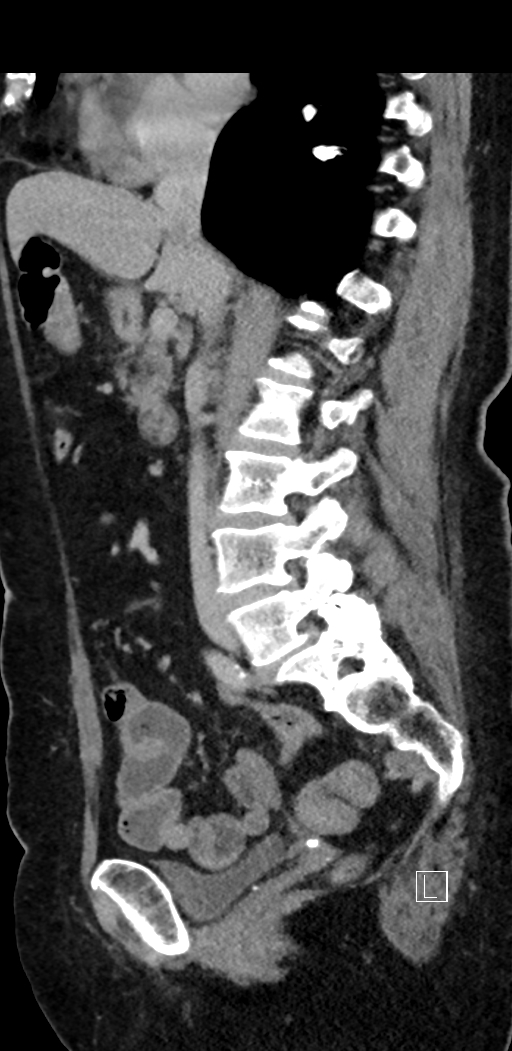 Appendiceal hemorrhage (Radiopaedia 70830-81025 Sagittal C+ delayed 51).jpg