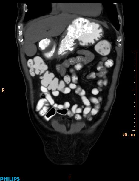 Appendiceal mucocoele (Radiopaedia 29449-29917 E 48).jpg