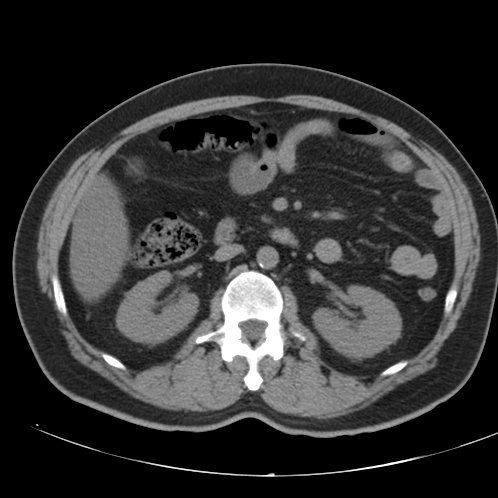 Appendicitis and giant appendicolith (Radiopaedia 80251-93588 Axial non-contrast 22).jpg