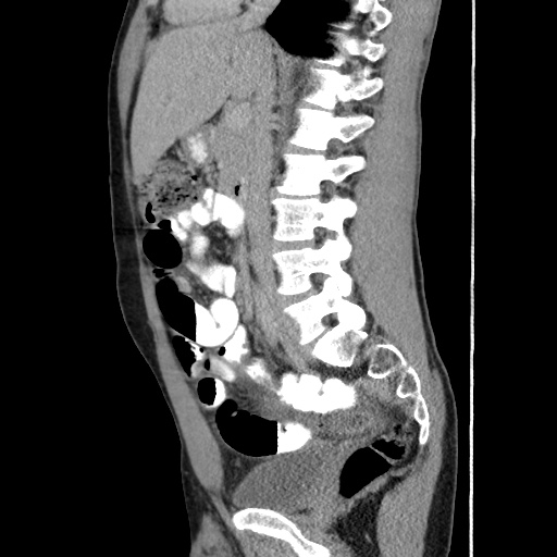Appendicitis complicated by post-operative collection (Radiopaedia 35595-37114 C 34).jpg