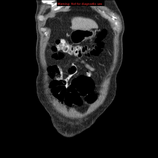 File:Appendicitis mass in inguinal hernia (Radiopaedia 26858-27029 B 4).jpg
