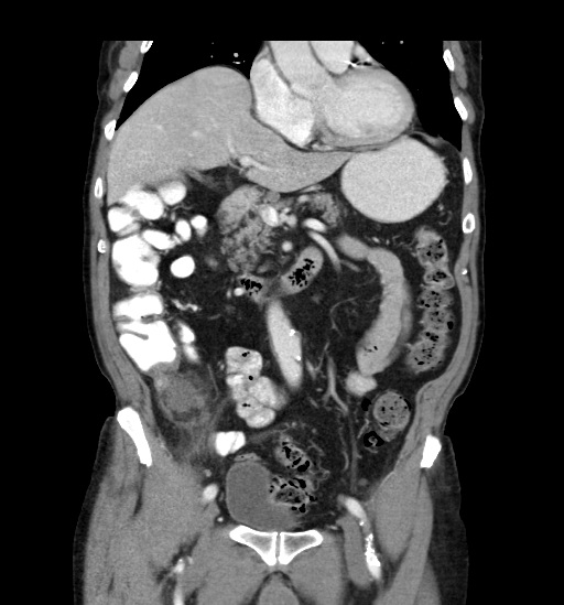 Appendicitis with localized perforation and abscess formation (Radiopaedia 49035-54130 B 21).jpg