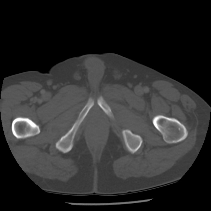Appendicitis with perforation (Radiopaedia 35790-37342 Axial bone window 57).jpg