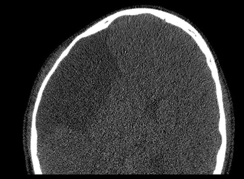 Arachnoid cyst- extremely large (Radiopaedia 68741-78450 Axial bone window 71).jpg
