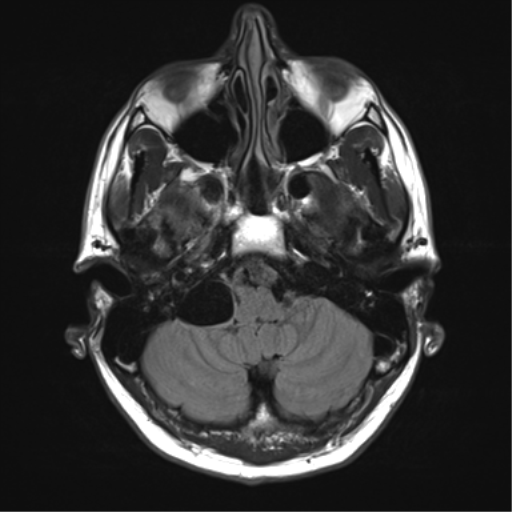 File:Arachnoid cyst - cerebellopontine angle (Radiopaedia 59689-67083 Axial FLAIR 7).png