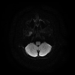 Arachnoid cyst - middle cranial fossa (Radiopaedia 86780-102938 Axial DWI 24).jpg