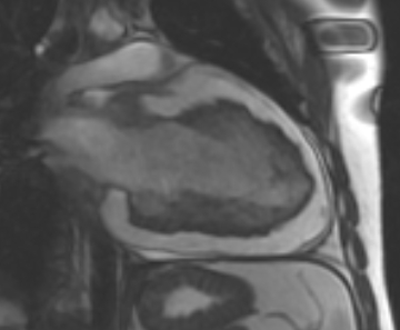 File:Arrhythmogenic right ventricular cardiomyopathy (Radiopaedia 69431-79307 2ch cine 15).jpg