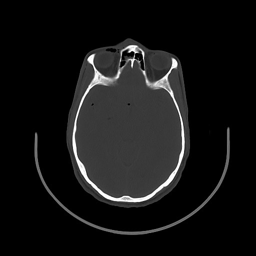 Arrow injury to the brain (Radiopaedia 72101-82607 Axial bone window 67).jpg