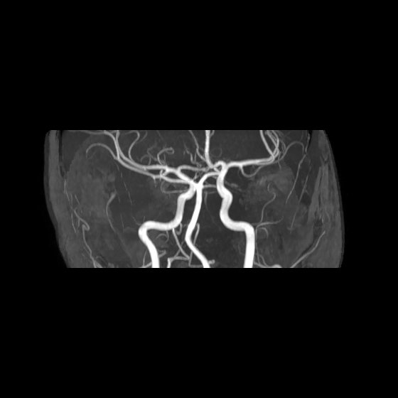 File:Artery of Percheron infarct (Radiopaedia 40966-43676 G 26).jpg