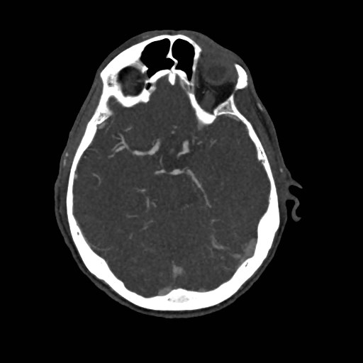 File:Artery of Percheron infarct (Radiopaedia 48088-52894 A 127).jpg
