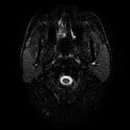 File:Artery of Percheron infarction (Radiopaedia 27975-28230 Axial DWI 25).jpg
