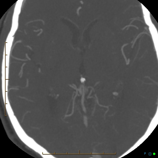 File:Artifactual basilar artery stenosis due to metallic stent (Radiopaedia 31206-31923 A 23).jpg