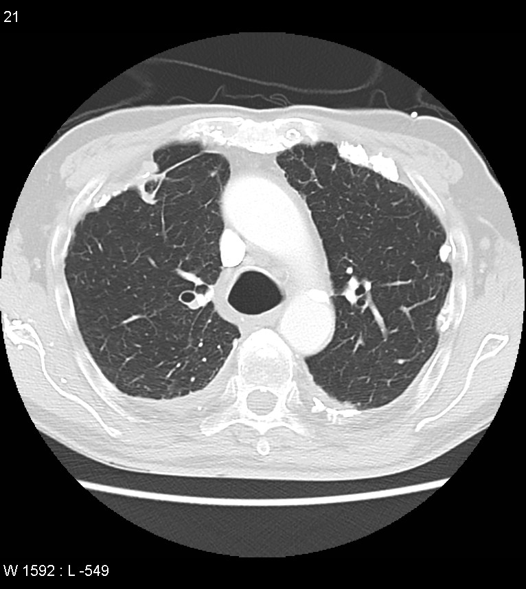 Asbestos related lung and pleural disease (Radiopaedia 14377-14301 A 18).jpg