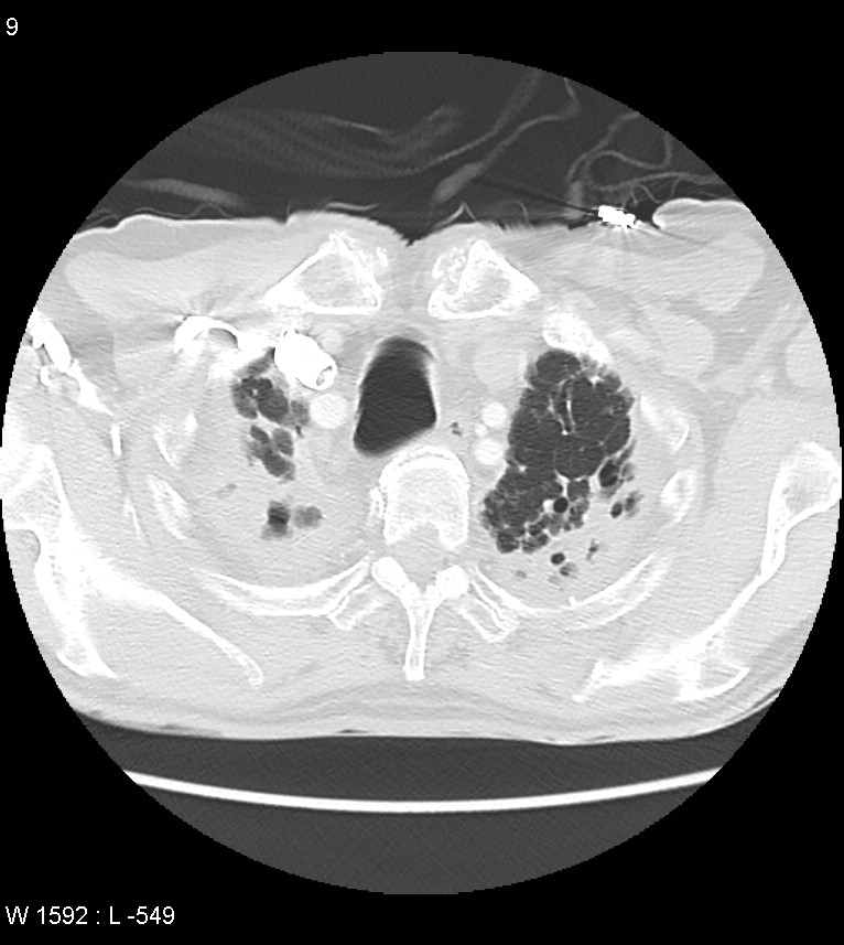 Asbestos related lung and pleural disease (Radiopaedia 14377-14301 A 6).jpg