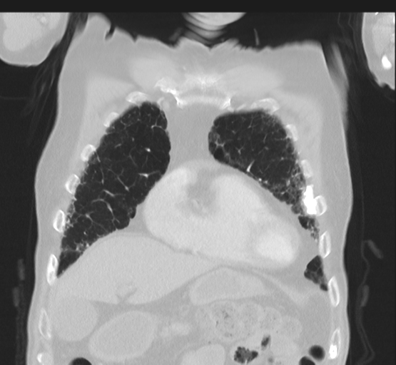 Asbestosis (Radiopaedia 56192-62864 Coronal lung window 13).png
