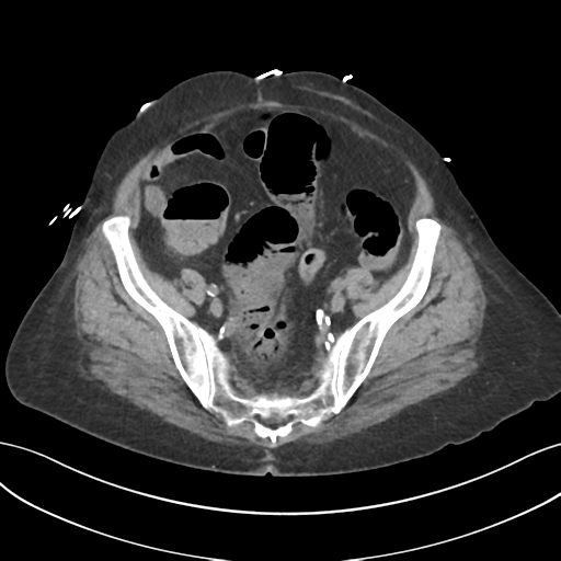File:Ascending cholangitis (Radiopaedia 39068-41253 Axial non-contrast 51).png