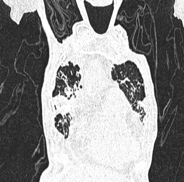 Aspergilloma- with Monod sign (Radiopaedia 44737-48532 Coronal lung window 141).jpg