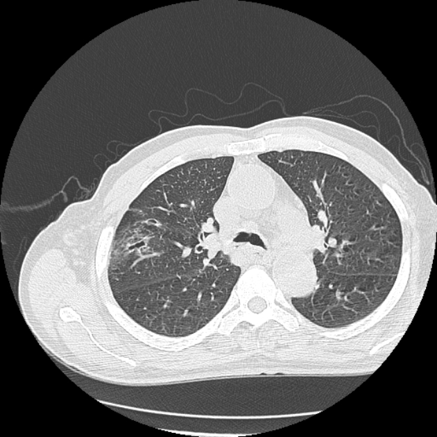Aspergilloma (Radiopaedia 44592-48327 Axial lung window 29).jpg