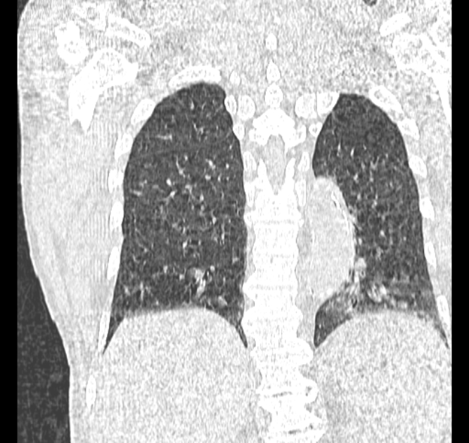 Aspergilloma (Radiopaedia 44592-48327 Coronal lung window 99).jpg