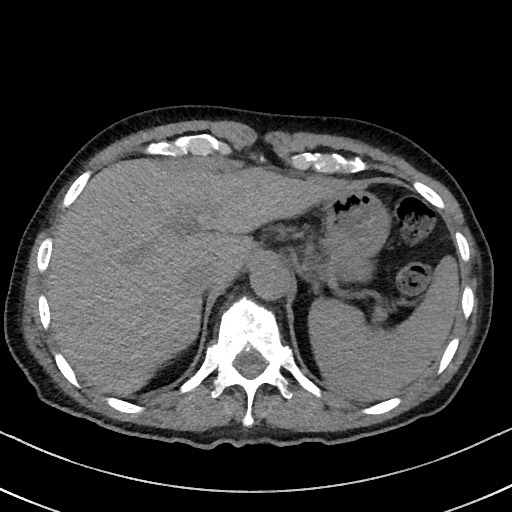 Aspergilloma on background pulmonary fibrosis (Radiopaedia 60942-68757 Axial non-contrast 54).jpg