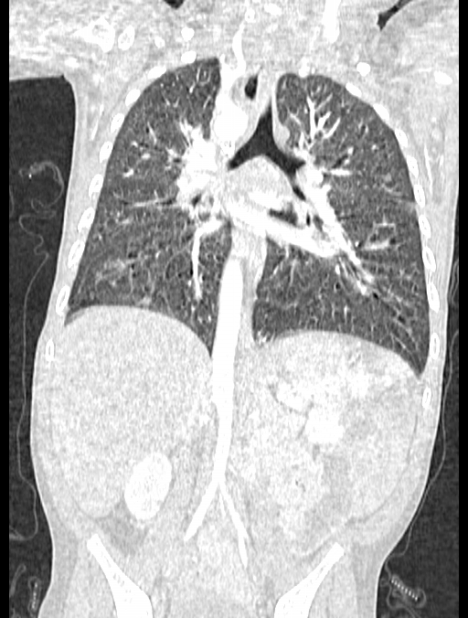 Asplenia syndrome (Radiopaedia 73083-83792 Coronal lung window 85).jpg