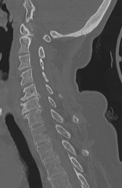 Atlanto-axial subluxation (Radiopaedia 36610-38176 Sagittal bone window 46).png