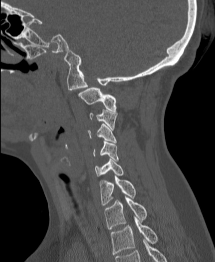 Atlanto-occipital assimilation with basilar invagination (Radiopaedia 70122-80188 Sagittal bone window 100).jpg