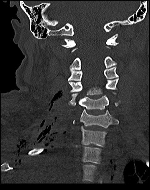 Atlanto-occipital dissociation - Traynelis type 1 (Radiopaedia 87570-103948 Coronal bone window 34).jpg