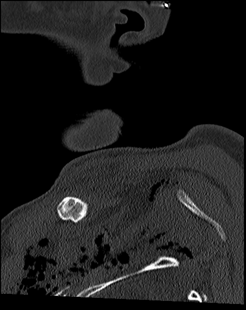 Atlanto-occipital dissociation - Traynelis type 1 (Radiopaedia 87570-103948 Sagittal bone window 7).jpg
