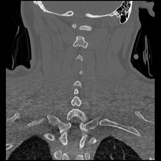 Atlanto-occipital dissociation injury (Radiopaedia 29274-29698 Coronal bone window 12).png