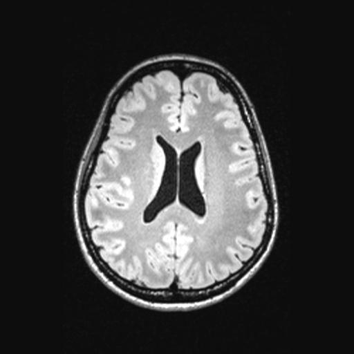 Atretic encephalocoele with inferior vermis hypoplasia (Radiopaedia 30443-31108 Axial 99).jpg