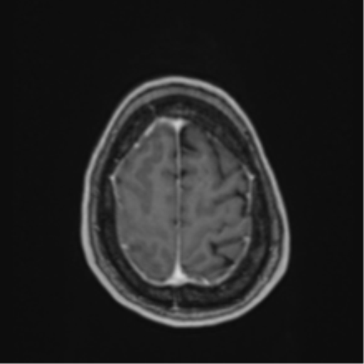 Atypical meningioma (WHO Grade II) (Radiopaedia 54742-60979 Axial T1 C+ 58).png