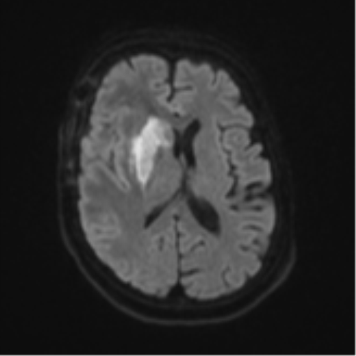 Atypical meningioma (WHO Grade II) (Radiopaedia 54742-60981 Axial DWI 44).png