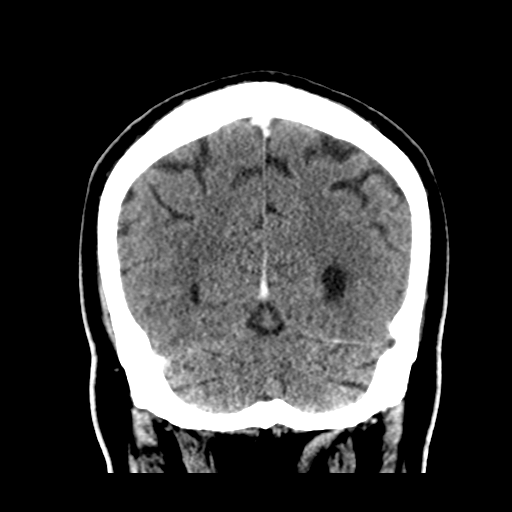 Atypical meningioma (WHO grade II) with brain invasion (Radiopaedia 57767-64728 Coronal C+ 49).png