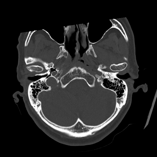 Atypical meningioma with skull invasion (Radiopaedia 34357-35649 Axial bone window 16).png