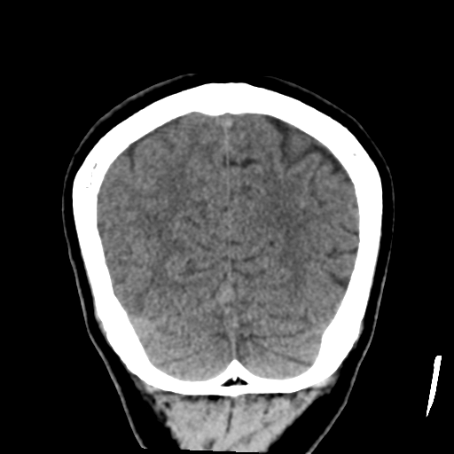 Atypical meningioma with skull invasion (Radiopaedia 34357-35649 Coronal non-contrast 51).png