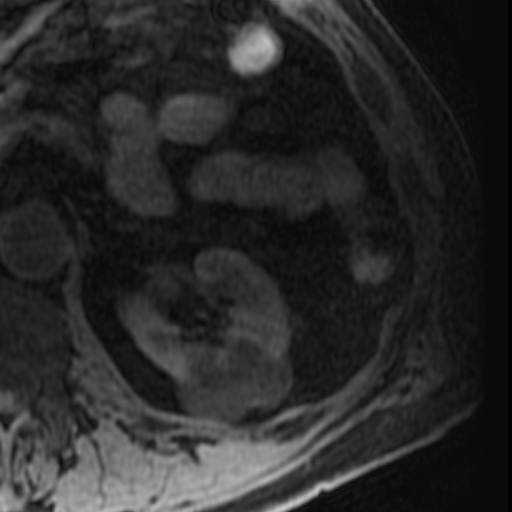 File:Atypical renal cyst on MRI (Radiopaedia 17349-17046 Axial T1 fat sat 13).jpg