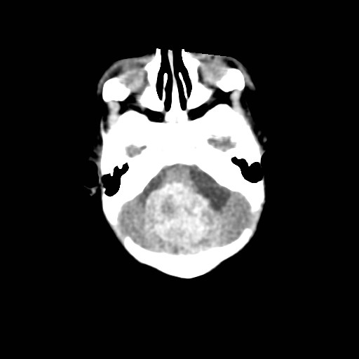 File:Atypical teratoid rhabdoid tumor (prenatal US and neonatal MRI) (Radiopaedia 59091-66387 Axial non-contrast 11).jpg