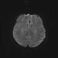 File:Autoimmune limbic encephalitis (Radiopaedia 30363-31005 Axial B0 and DWI 53).jpg