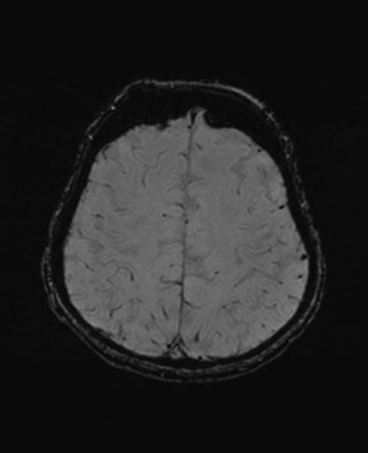 Autoimmune limbic encephalitis (Radiopaedia 30363-31005 SWI 60).jpg