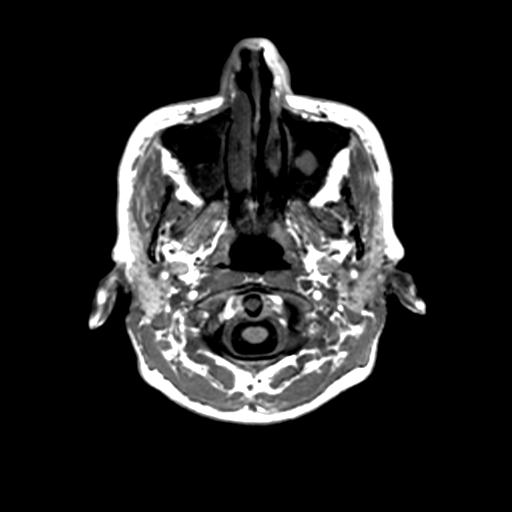 Autoimmune limbic encephalitis (Radiopaedia 30363-31005 T1 Axial 1mm 9).jpg