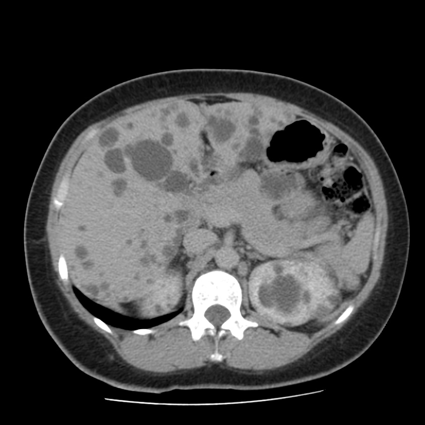 Autosomal dominant polycystic kidney disease (Radiopaedia 23061-23093 C+ delayed 21).jpg