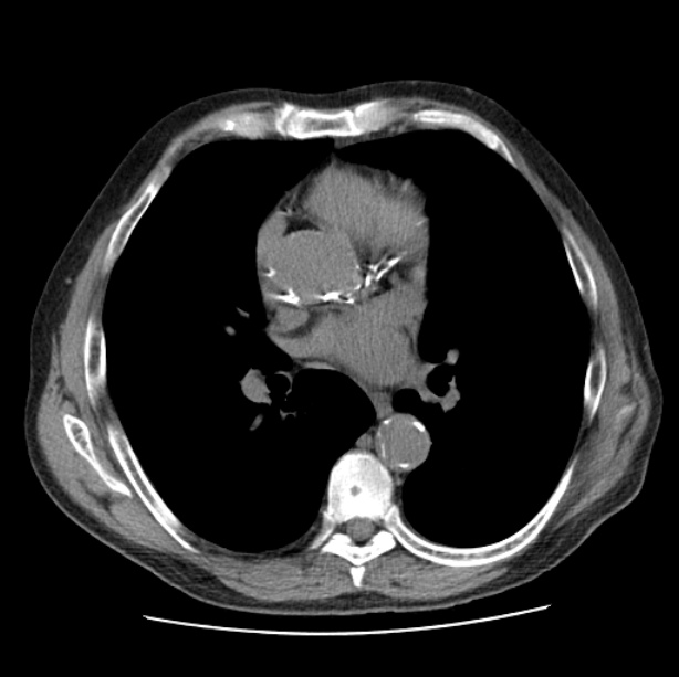 Autosomal dominant polycystic kidney disease (Radiopaedia 27851-28094 Axial non-contrast 30).jpg