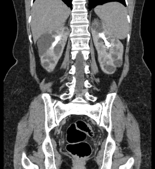 Autosomal dominant polycystic kidney disease (Radiopaedia 38189-40194 Coronal C+ delayed 74).jpg