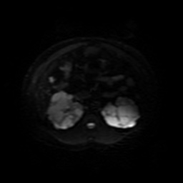 Autosomal dominant polycystic kidney disease (Radiopaedia 50259-55611 Axial DWI 20).jpg