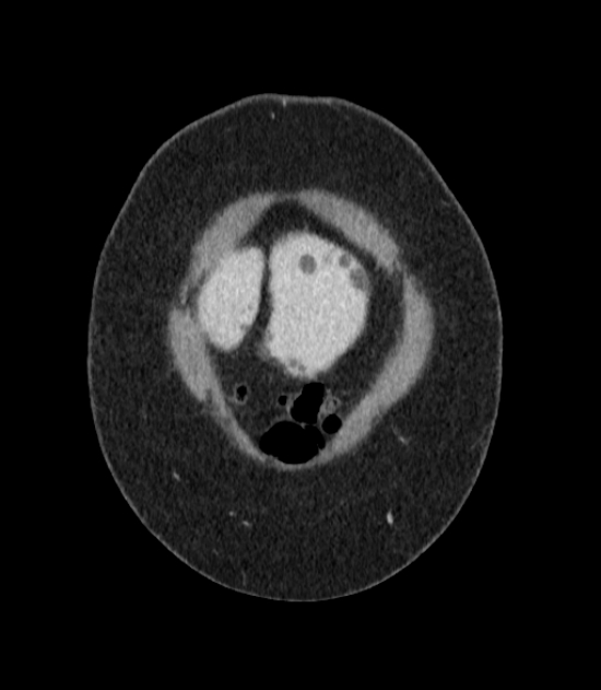 Autosomal dominant polycystic kidney disease (Radiopaedia 57124-64017 B 1).jpg
