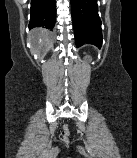 Autosomal dominant polycystic kidney disease (Radiopaedia 57124-64017 B 64).jpg