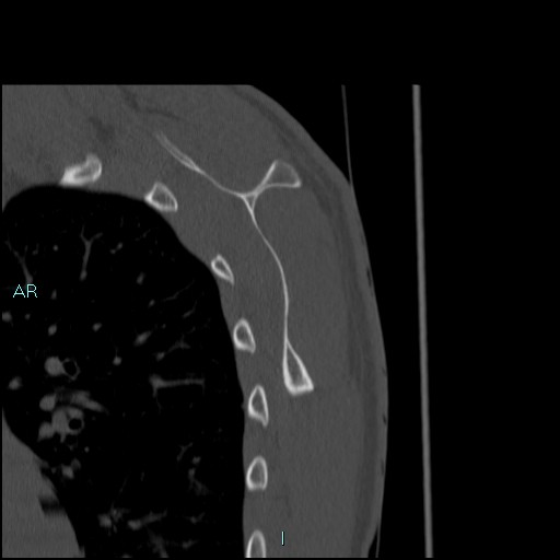 Avascular necrosis after fracture dislocations of the proximal humerus (Radiopaedia 88078-104653 Sagittal bone window 66).jpg